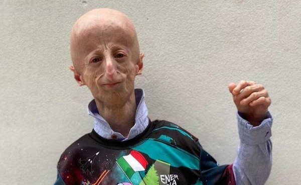 Умер самый долгоживущий человек с синдромом преждевременного старения &mdash; ему было 28 лет